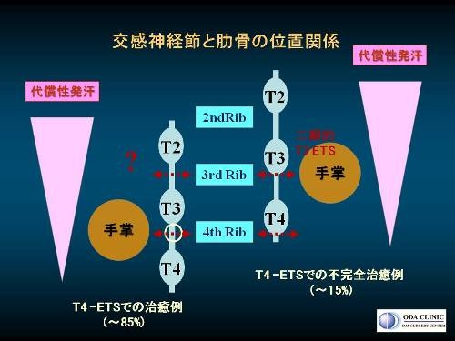 低位交感神経遮断手術（T4-ETS）後に少し手汗がでる場合の神経分布の個人差